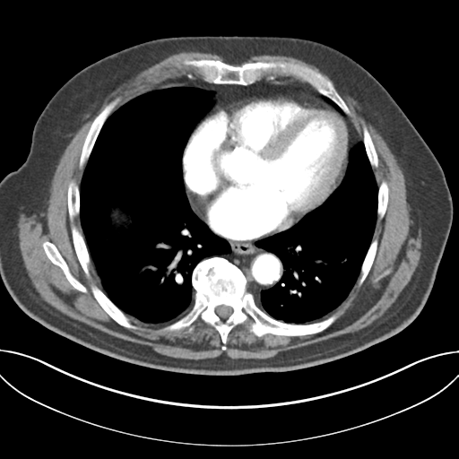 File:Adenocarcioma of rectum- T1 lesion (Radiopaedia 36921-38547 Axial C+ arterial phase 36).png