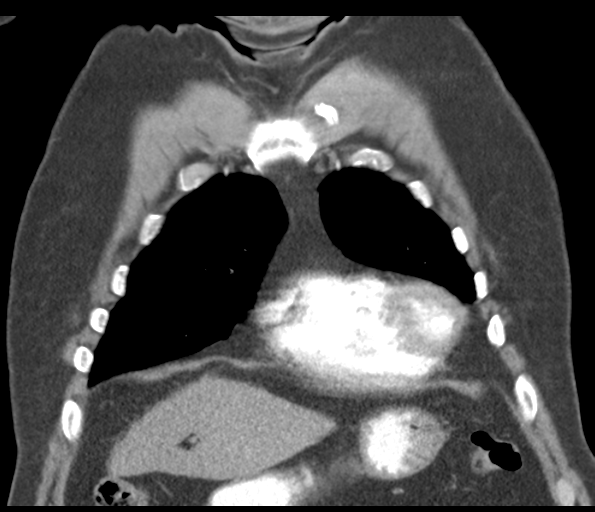 Adenocarcioma of rectum- T1 lesion (Radiopaedia 36921-38547 Coronal C+ arterial phase 18).png