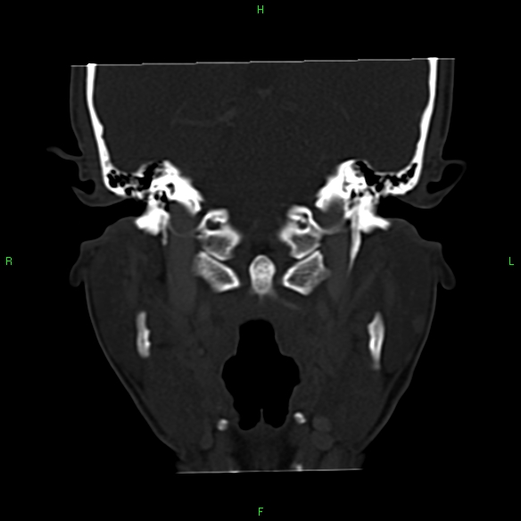 File:Adenoid cystic carcinoma of hard palate (Radiopaedia 26137-26273 Coronal bone window 24).jpg