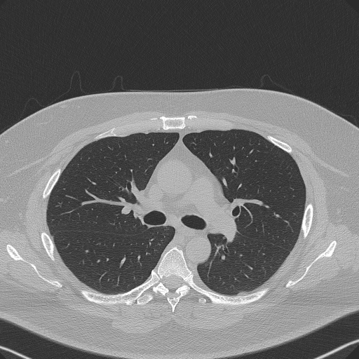 Adenoid cystic carcinoma of the trachea (Radiopaedia 49042-54137 Axial lung window 140).jpg