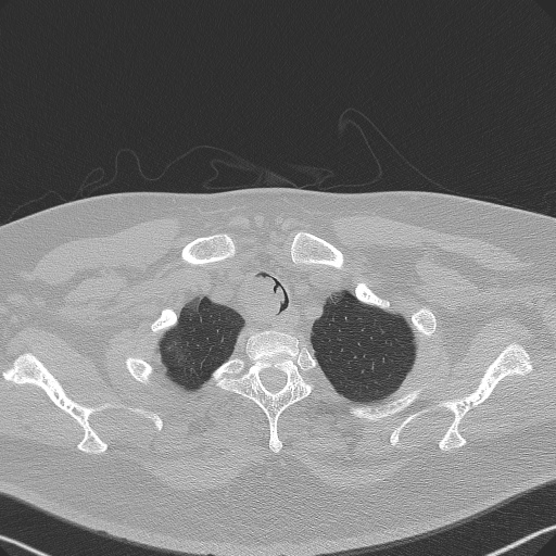 Adenoid cystic carcinoma of the trachea (Radiopaedia 49042-54137 Axial lung window 36).jpg