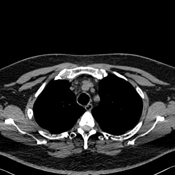 Adenoid cystic carcinoma of the trachea (Radiopaedia 49042-54137 Axial non-contrast 75).jpg