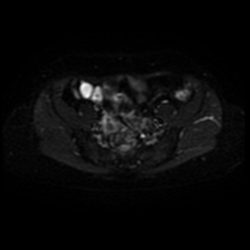 File:Adenoma malignum of cervix (Radiopaedia 66441-75705 Axial DWI 4).jpg