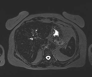 File:Adenomyomatosis of the gallbladder (Radiopaedia 50246-55587 Axial 91).png