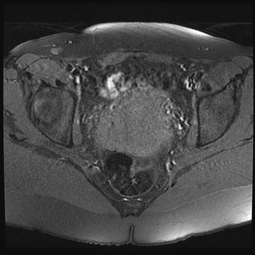 File:Adenomyosis-scar endometriosis (Radiopaedia 65863-75022 Axial T1 fat sat 17).jpg