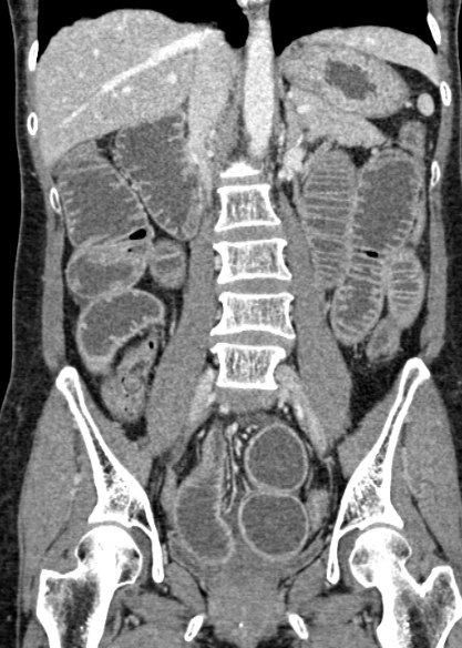 Adhesional small bowel obstruction (Radiopaedia 48397-53305 Coronal C+ portal venous phase 198).jpg