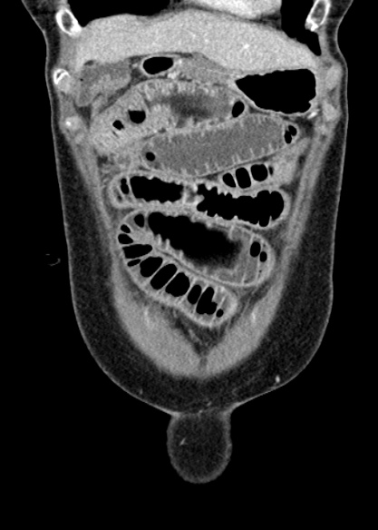 Adhesional small bowel obstruction (Radiopaedia 48397-53305 Coronal C+ portal venous phase 64).jpg