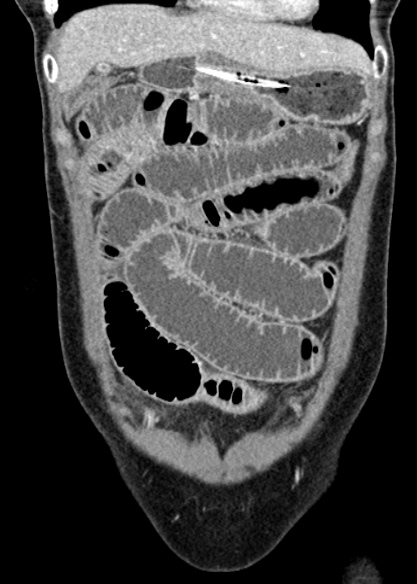 Adhesional small bowel obstruction (Radiopaedia 48397-53305 Coronal C+ portal venous phase 86).jpg