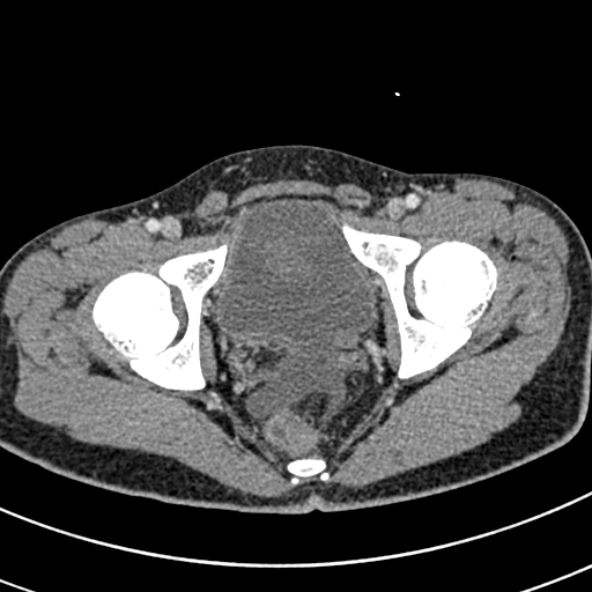 File:Adhesional small bowel obstruction (Radiopaedia 52107-57980 Axial C+ portal venous phase 121).jpg