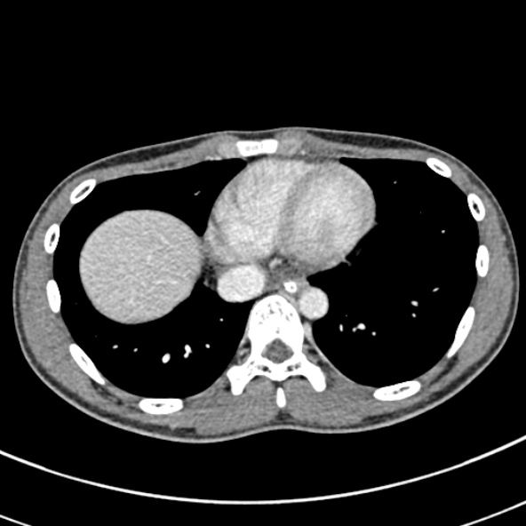 File:Adhesional small bowel obstruction (Radiopaedia 52107-57980 Axial C+ portal venous phase 4).jpg