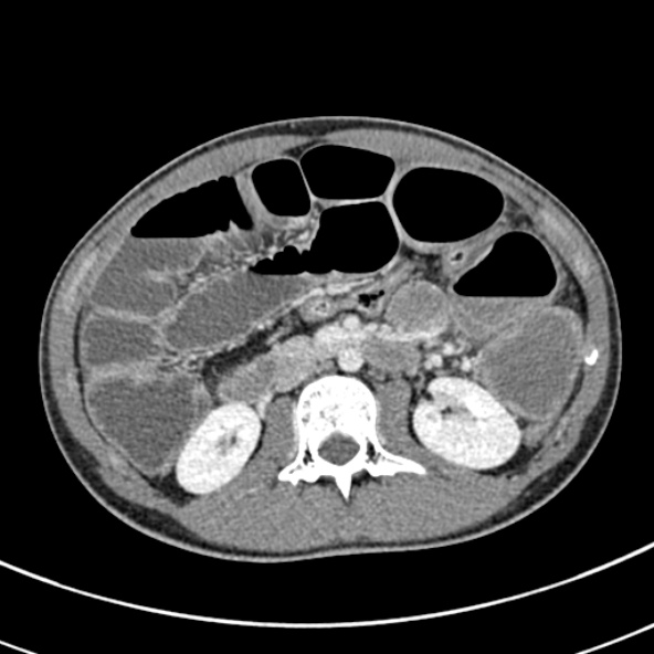 File:Adhesional small bowel obstruction (Radiopaedia 52107-57980 Axial C+ portal venous phase 50).jpg