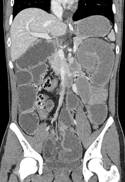 Adhesional small bowel obstruction (Radiopaedia 52107-57980 Coronal C+ portal venous phase 40).jpg