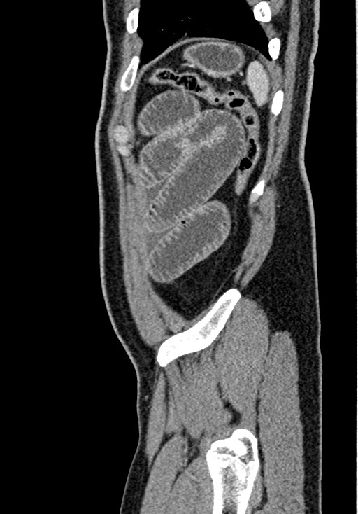 Adhesional small bowel obstruction (Radiopaedia 58900-66131 Sagittal C+ portal venous phase 220).jpg