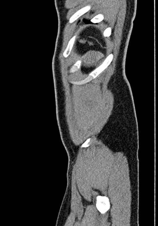 Adhesional small bowel obstruction (Radiopaedia 58900-66131 Sagittal C+ portal venous phase 235).jpg
