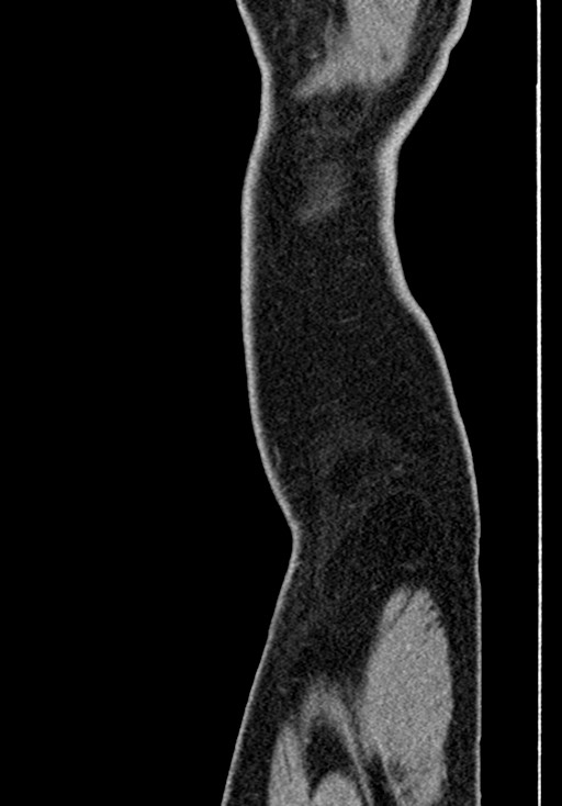 Adhesional small bowel obstruction (Radiopaedia 58900-66131 Sagittal C+ portal venous phase 249).jpg