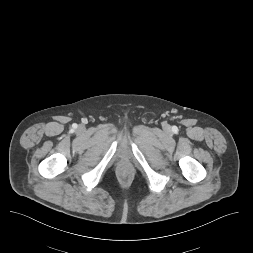 Adhesions within abdominal wall hernia (Radiopaedia 58283-65394 Axial C+ portal venous phase 90).png