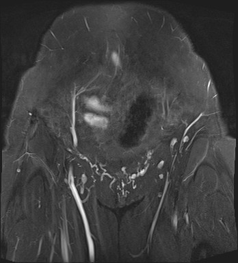 File:Adnexal multilocular cyst (O-RADS US 3- O-RADS MRI 3) (Radiopaedia 87426-103754 Coronal T2 fat sat 4).jpg