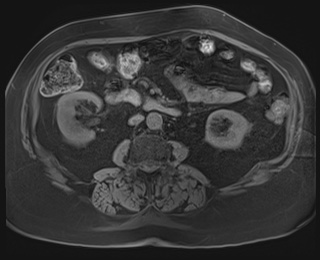 Adrenal cortical carcinoma (Radiopaedia 64017-72770 Axial T1 fat sat 52).jpg