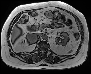 File:Adrenal cortical carcinoma (Radiopaedia 64017-72770 Axial T1 out-of-phase 34).jpg