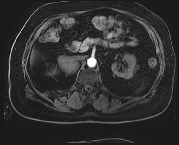Adrenal cortical carcinoma (Radiopaedia 64017-72770 H 17).jpg