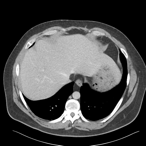 File:Adrenal cyst (Radiopaedia 45625-49777 Axial C+ portal venous phase 18).png