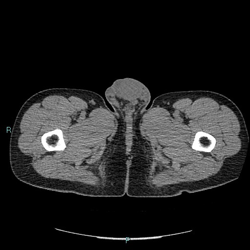 File:Adrenal cystic lymphangioma (Radiopaedia 83161-97534 Axial non-contrast 114).jpg