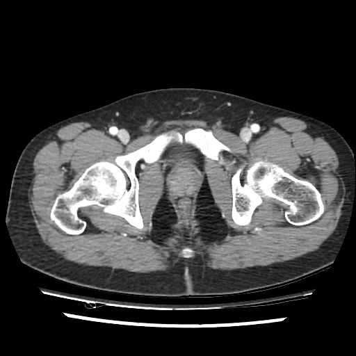 File:Adrenal gland trauma (Radiopaedia 81351-95078 Axial Dual bolus trauma C+ 120).jpg