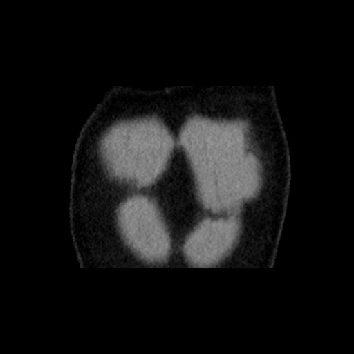 Adrenal gland trauma (Radiopaedia 81351-95079 Coronal non-contrast 10).jpg