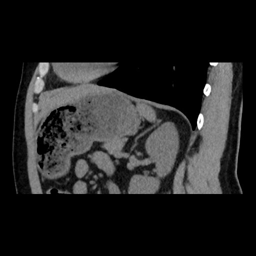 Adrenal gland trauma (Radiopaedia 81351-95079 Sagittal non-contrast 68).jpg