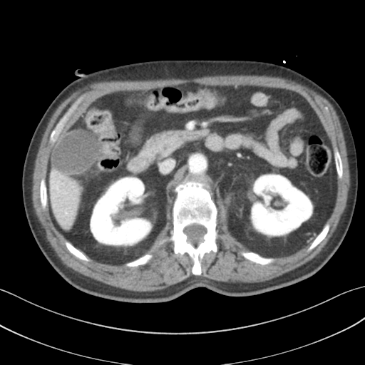 File:Adrenal hematoma (Radiopaedia 44334-47968 Axial C+ portal venous phase 31).png