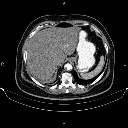 Adrenal hemorrhage (Radiopaedia 62622-70916 Axial C+ arterial phase 55).jpg