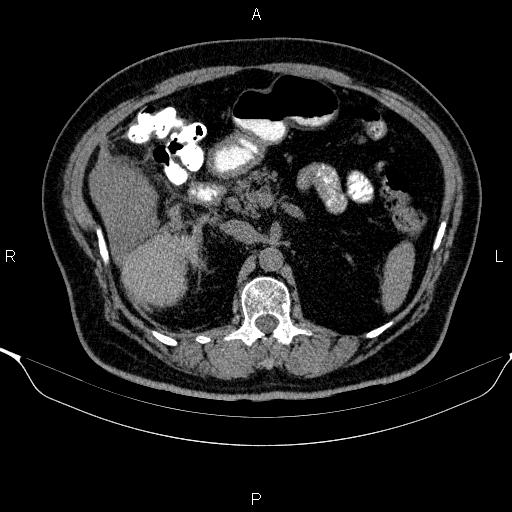 Adrenal hemorrhage (Radiopaedia 62622-70916 Axial non-contrast 68).jpg