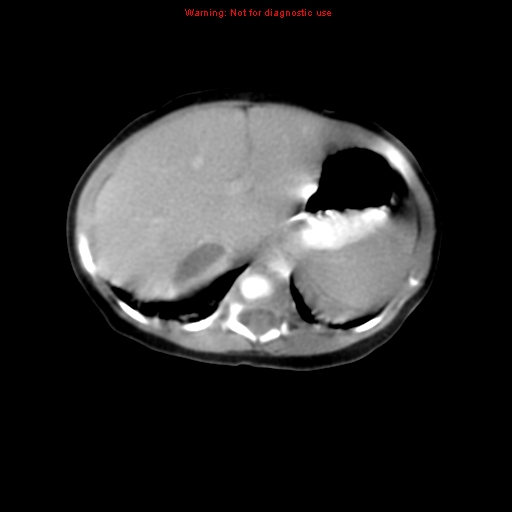 File:Adrenal hemorrhage (Radiopaedia 9390-10077 Axial C+ portal venous phase 3).jpg