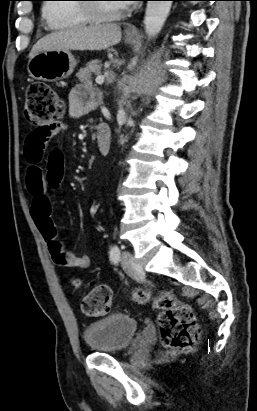 Adrenal lymphoma (Radiopaedia 73730-84529 Sagittal C+ portal venous phase 65).jpg