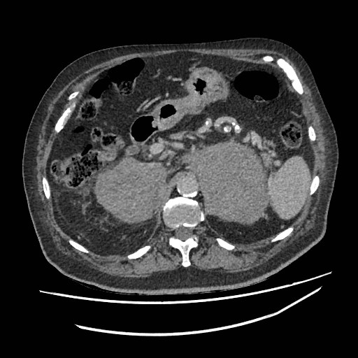 Adrenal lymphoma (Radiopaedia 84145-99415 Axial C+ portal venous phase 32).jpg
