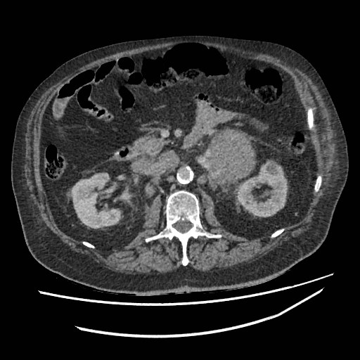 Adrenal lymphoma (Radiopaedia 84145-99415 Axial C+ portal venous phase 54).jpg