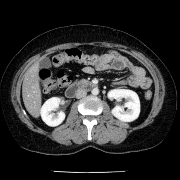 Adrenal myelolipoma (Radiopaedia 43401-46759 Axial C+ portal venous phase 39).jpg