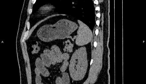 Adrenal myelolipoma (Radiopaedia 84321-99619 Sagittal non-contrast 83).jpg
