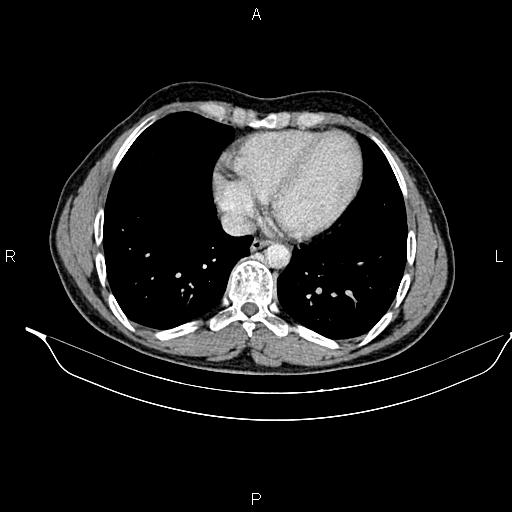 Adrenal myelolipoma (Radiopaedia 87794-104246 Axial renal cortical phase 7).jpg