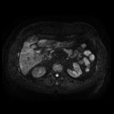 File:Adrenal myelolipoma - MRI (Radiopaedia 83249-97646 Axial DWI 14).jpg