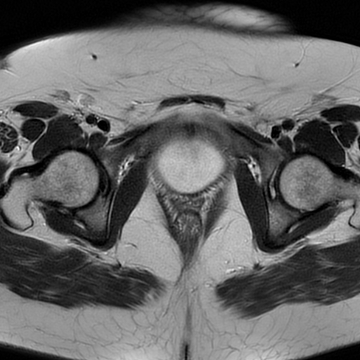 File:Adult granulosa cell tumor of the ovary (Radiopaedia 64991-73953 Axial T2 20).jpg