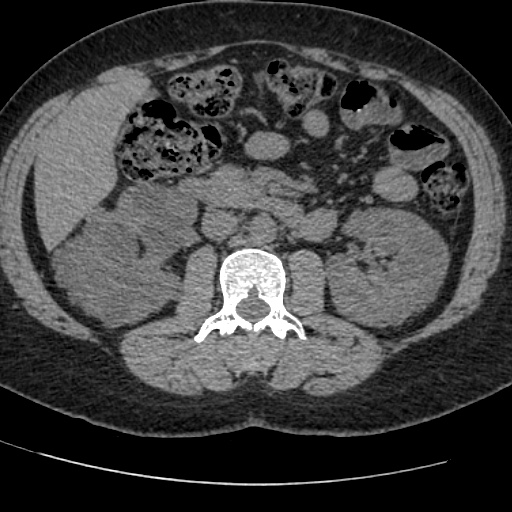 Adult polycystic kidney disease (Radiopaedia 59075-66368 Axial non-contrast 35).jpg