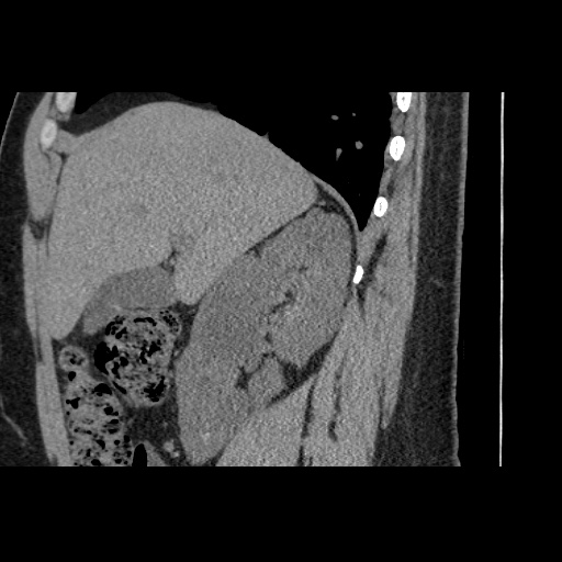 Adult polycystic kidney disease (Radiopaedia 59075-66368 Sagittal non-contrast 22).jpg