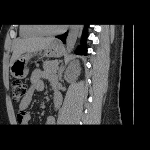 Adult polycystic kidney disease (Radiopaedia 59075-66368 Sagittal non-contrast 53).jpg