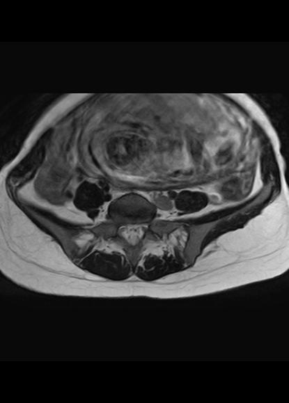 File:Aggressive angiomyxoma of the pelvis and perineum (Radiopaedia 59162-66479 Axial T2 25).jpg