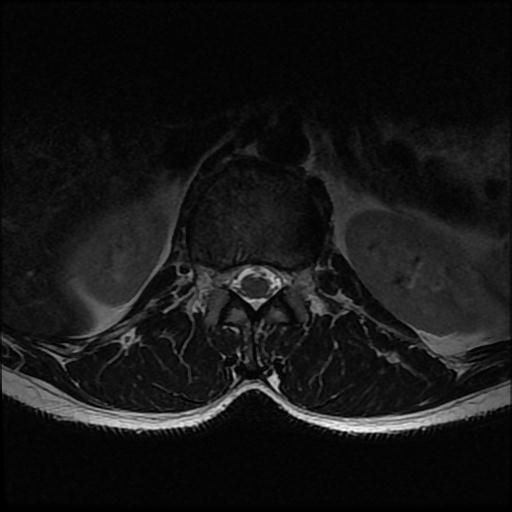 File:Aggressive vertebral hemangioma with pathological fracture (Radiopaedia 69528-79411 Axial T2 17).jpg
