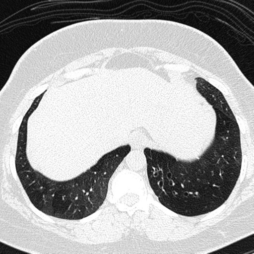 Air trapping in small airway disease (Radiopaedia 61685-69694 Axial lung window 161).jpg