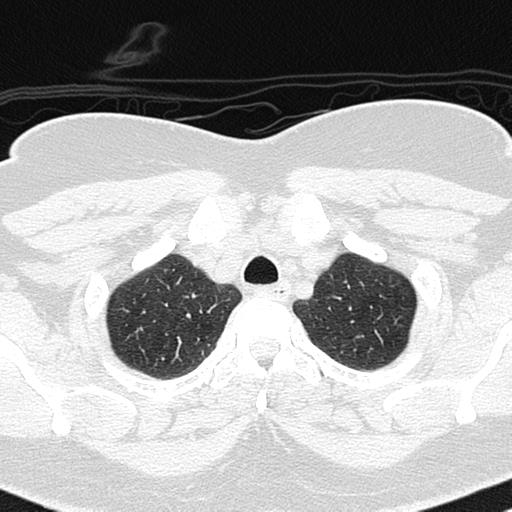 Air trapping in small airway disease (Radiopaedia 61685-69694 Axial lung window 23).jpg