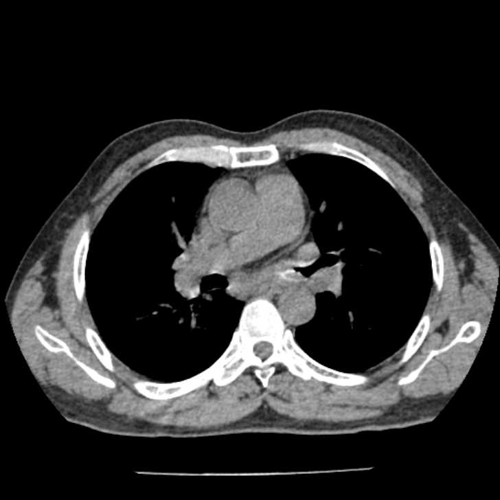 Airway foreign body in adult (Radiopaedia 85907-101779 Axial liver window 73).jpg