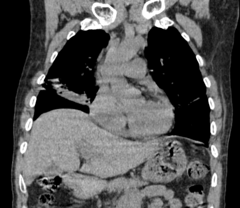 Airway foreign body in adult (Radiopaedia 85907-101779 Coronal liver window 96).jpg